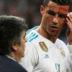 Tiga Jahitan untuk Luka di Kepala Christiano Ronaldo